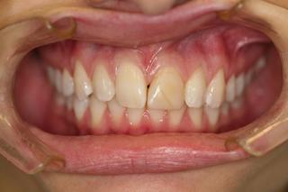 Crown and Veneer before