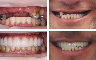 A Long-Term Solution for Missing Teeth