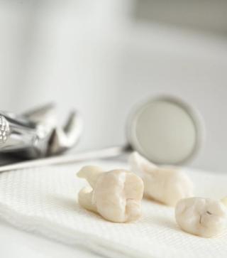Precision meets care with tooth extractions