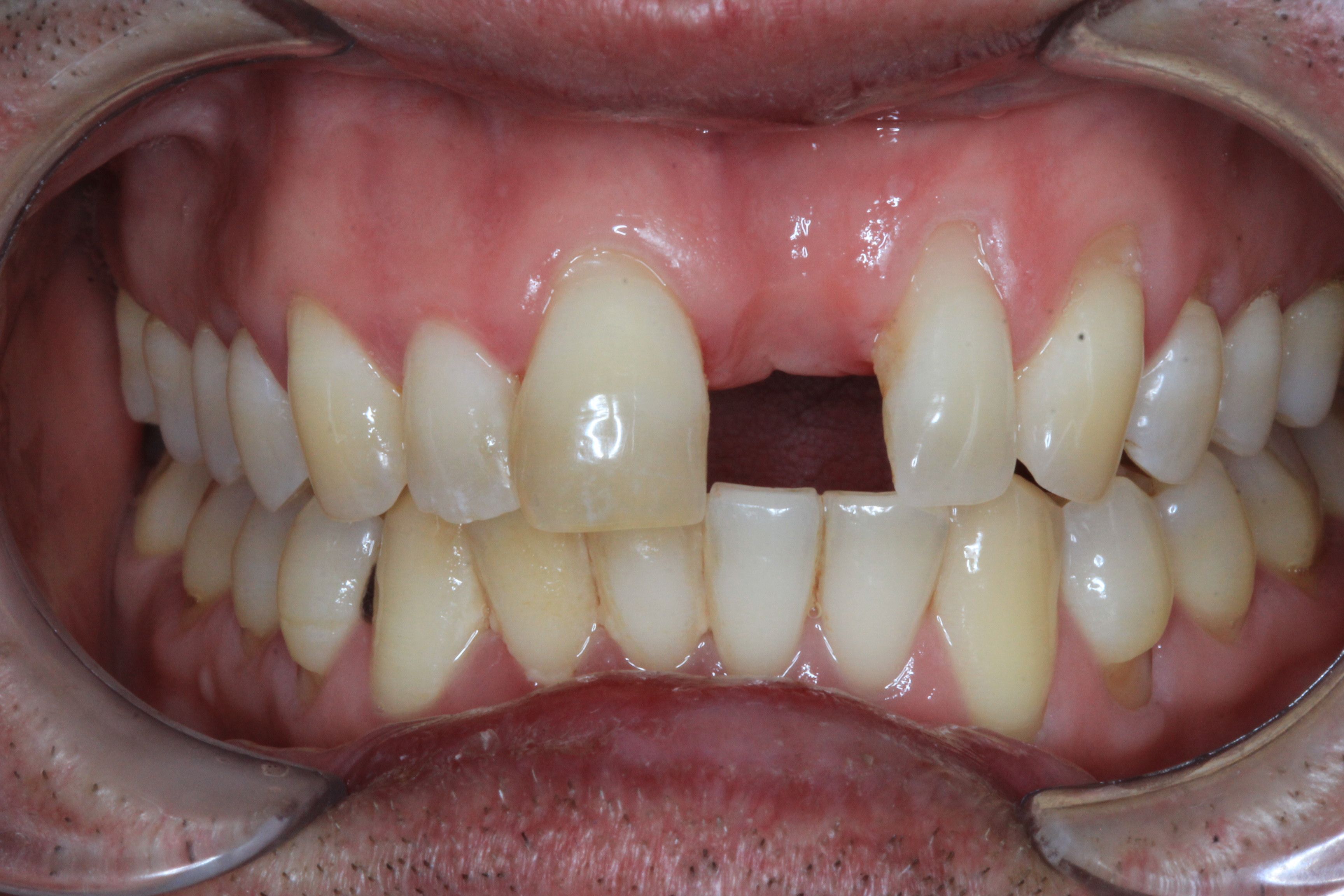 Implant and Root coverage surgery before