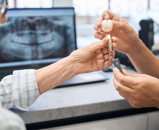 Affordable Dental Implants in Werribee