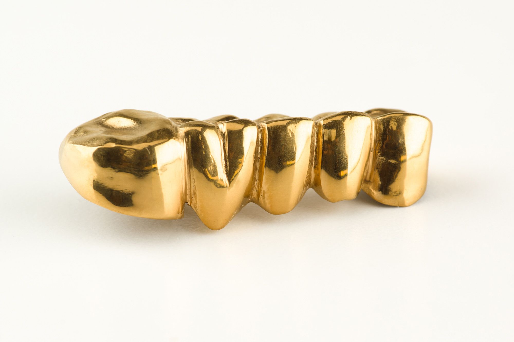 Metal crowns (gold or alloy)