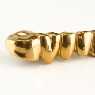 Metal crowns (gold or alloy)