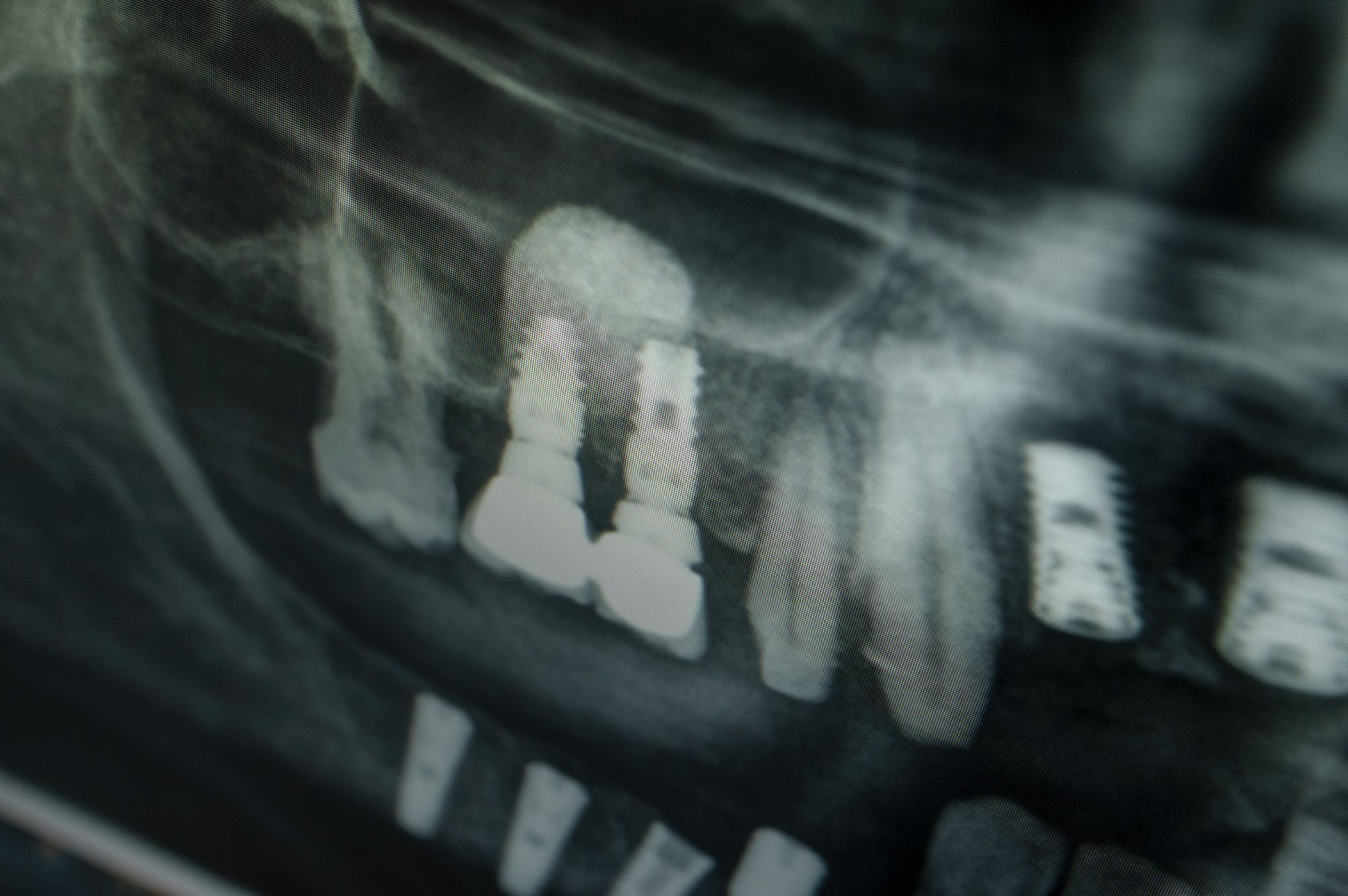 The Dental Implant Procedure