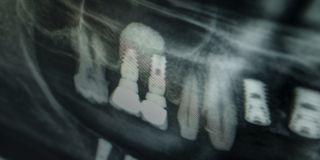 The Dental Implant Procedure