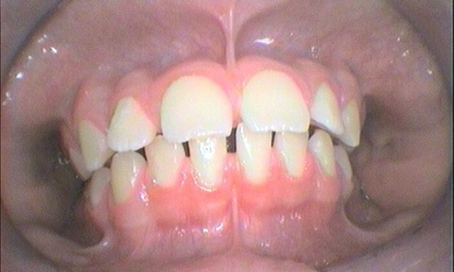 Braces and Invisalign - Before