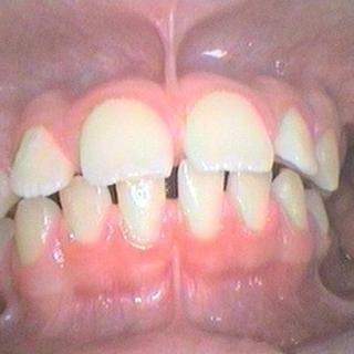 Braces and Invisalign - Before