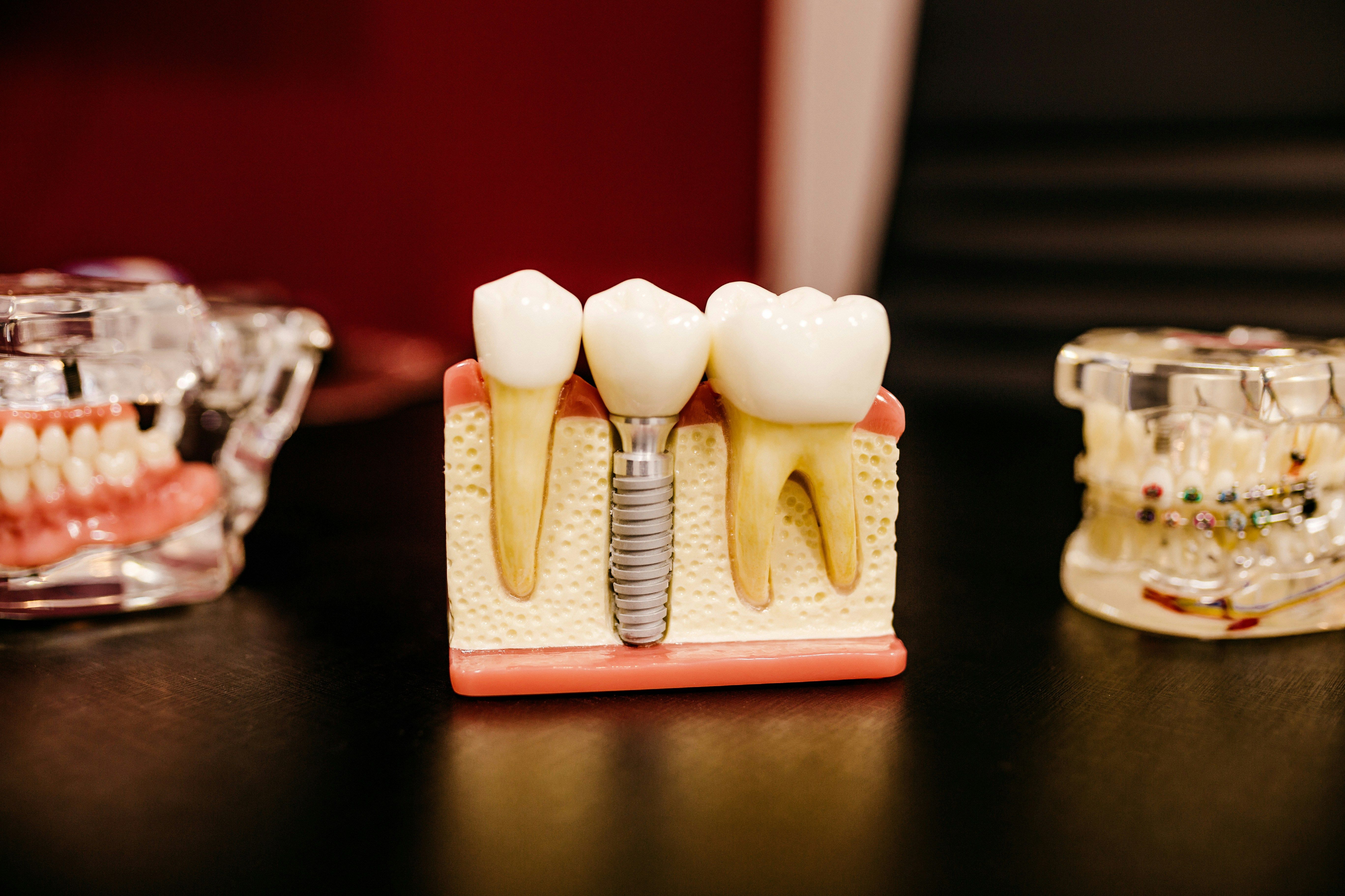What are dental fillings?