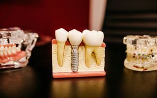 What are dental fillings?