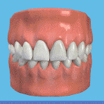 Gif image on how dental bridge are installed.