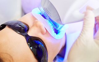 In-chair teeth whitening example