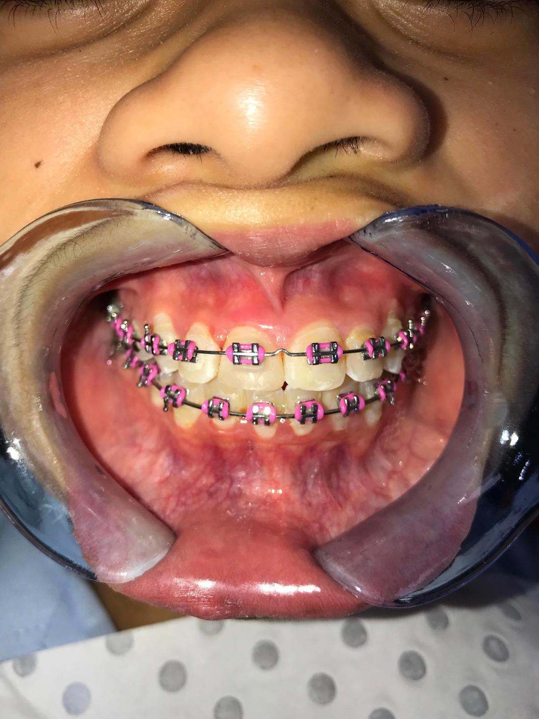 Braces and Invisalign - After