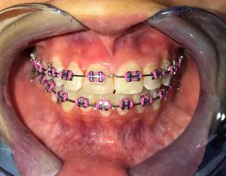 Braces and Invisalign - After