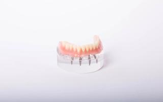 Image of a set of implanted-supported dentures.