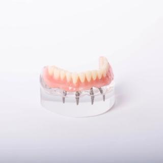 Image of implant supported dentures.