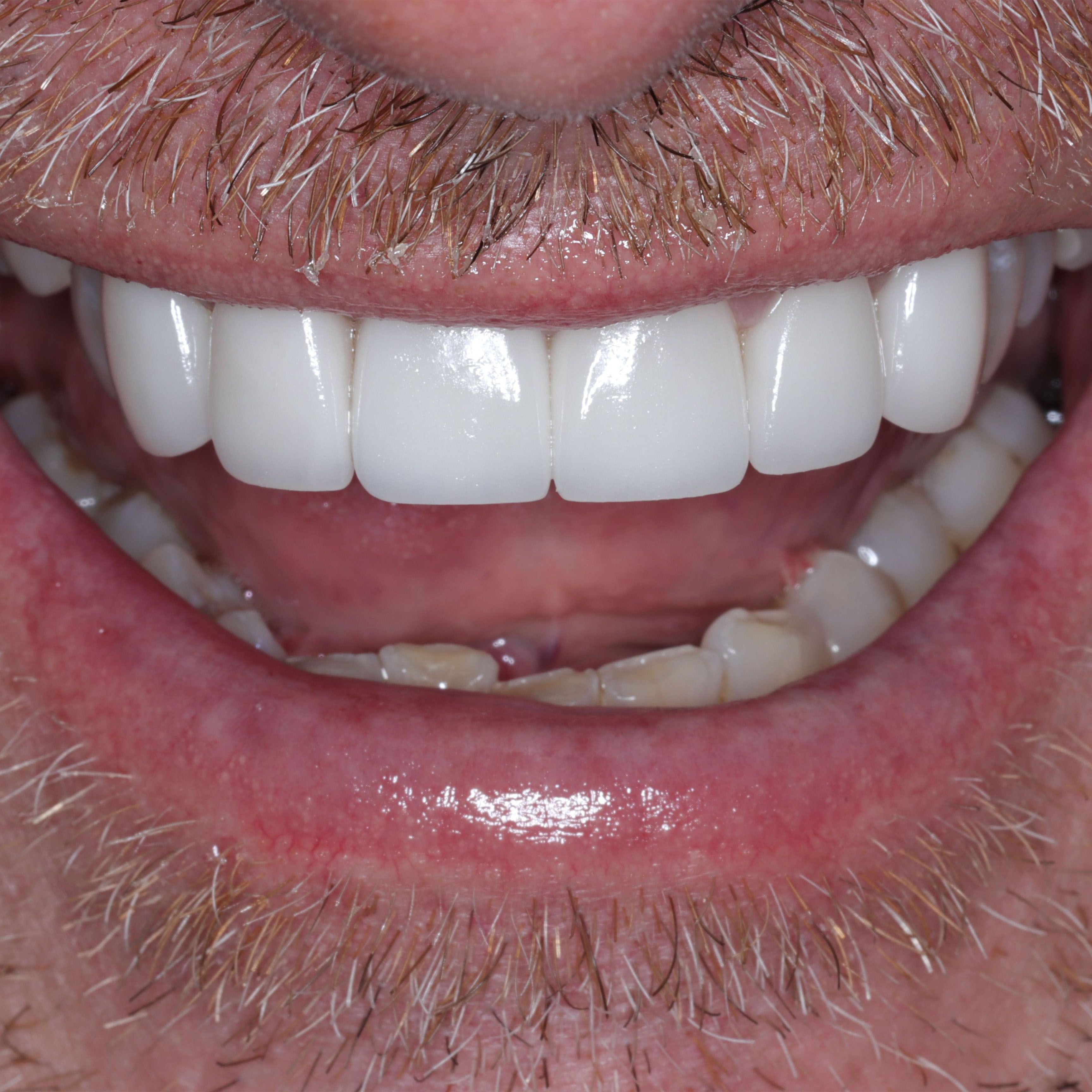 Porcelain Veneers & Crowns After