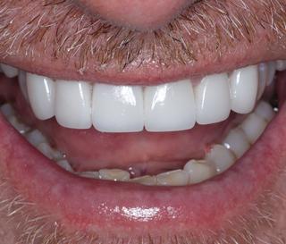 Porcelain Veneers & Crowns After