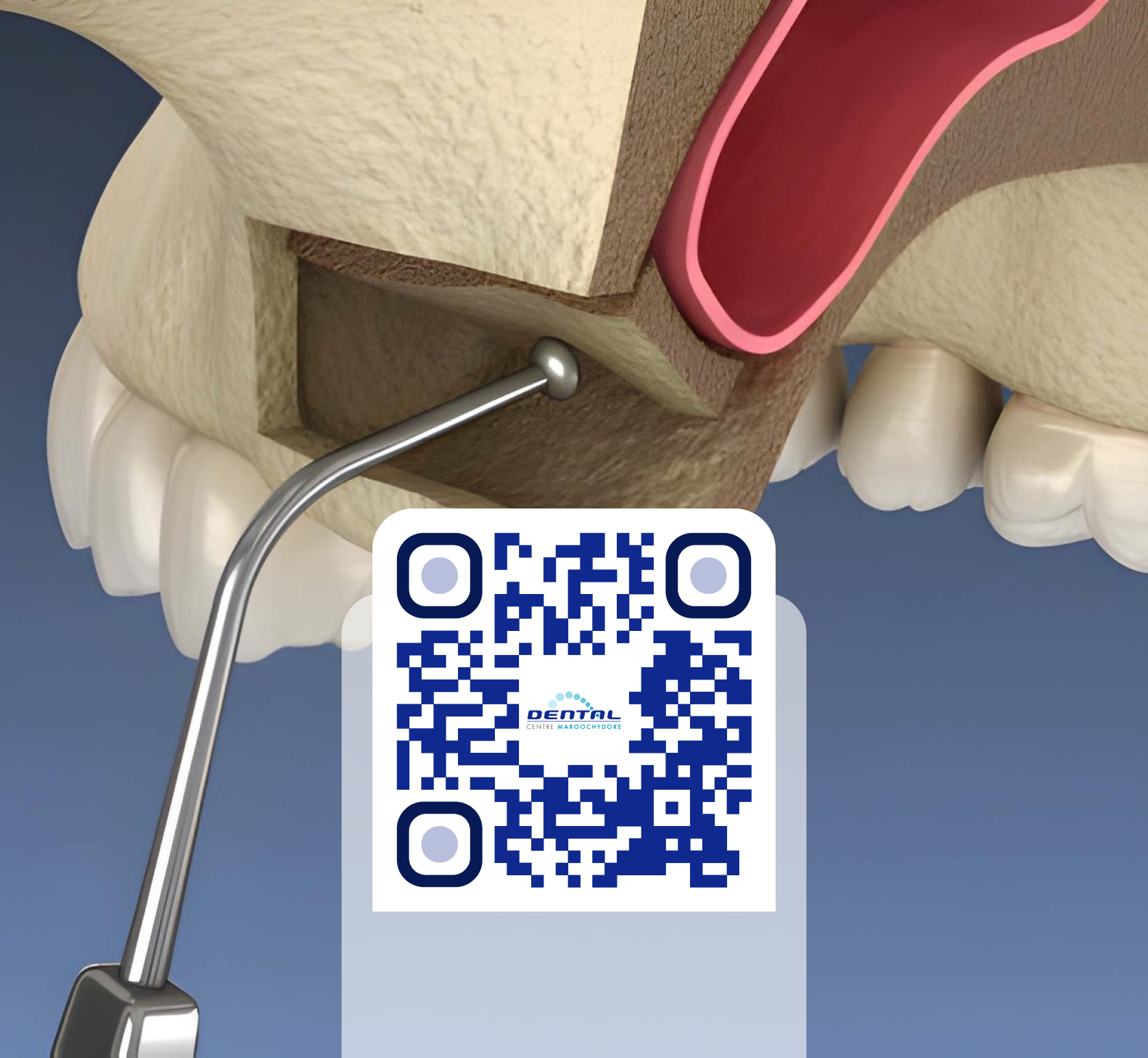 sinus lift consent form qr code