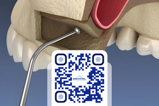 sinus lift consent form qr code