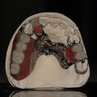 Image of a partial set of chrome cobalt dentures.