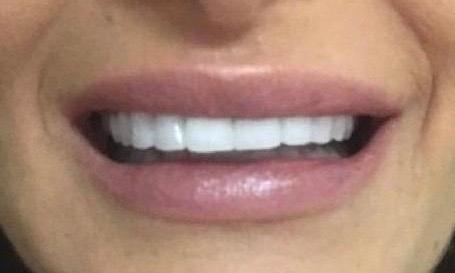 Cosmetic Dentistry - After