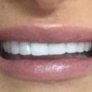Cosmetic Dentistry - After