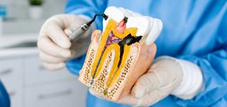 Root Canal Treatment