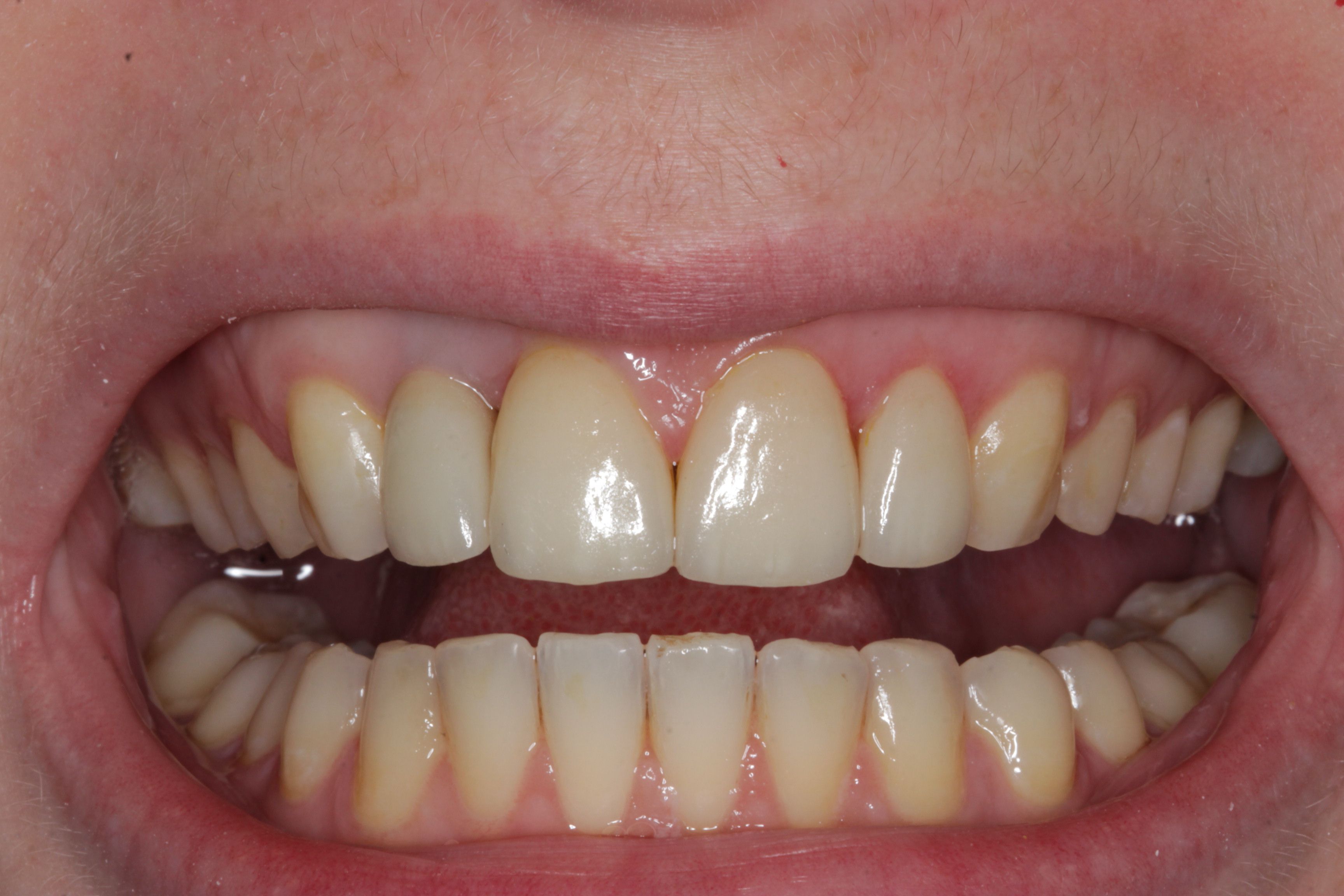 Front Tooth Implant and Veneers before