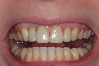 Front Tooth Implant and Veneers before