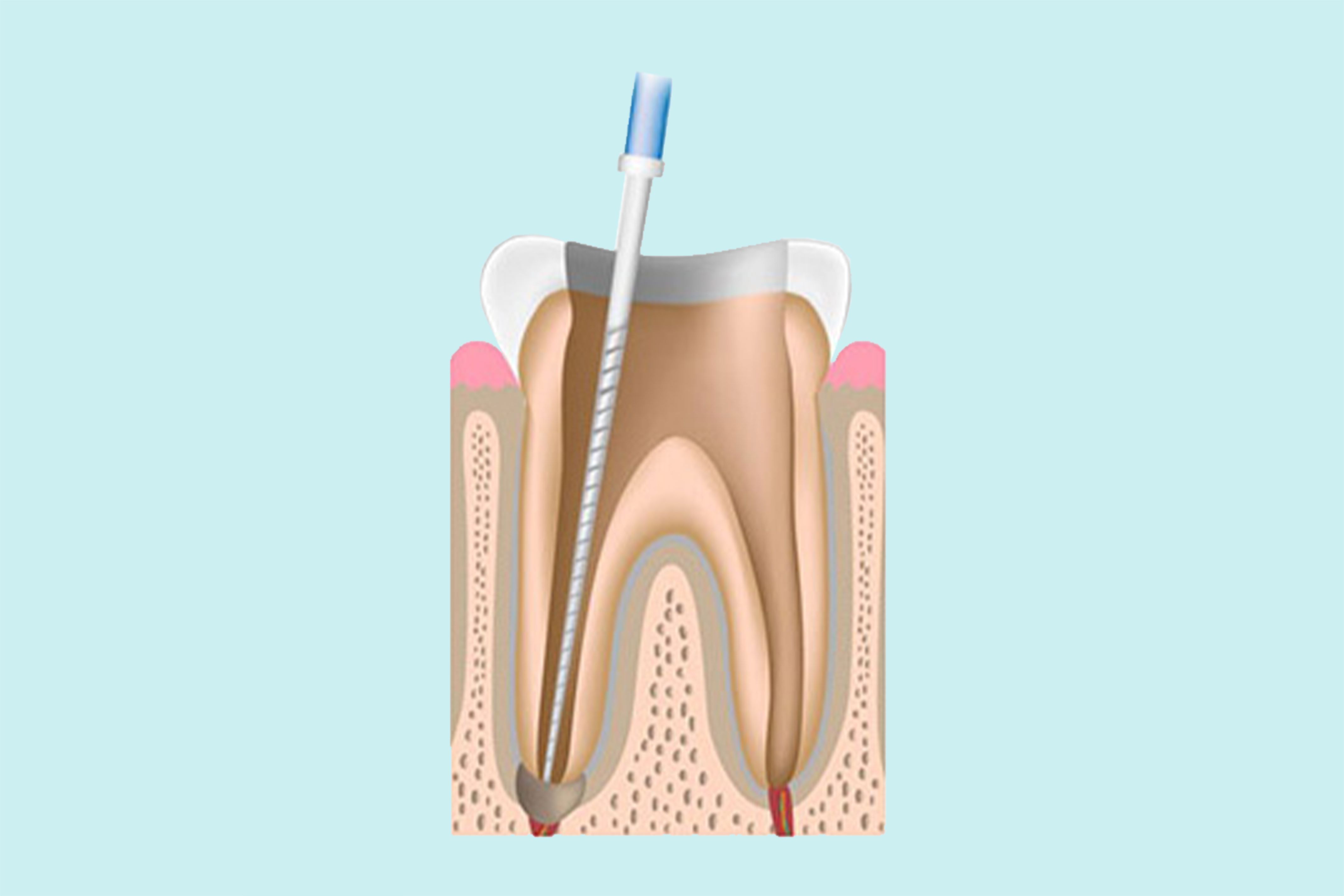Step 1 — Cleaning the tooth
