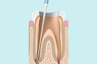 Step 1 — Cleaning the tooth
