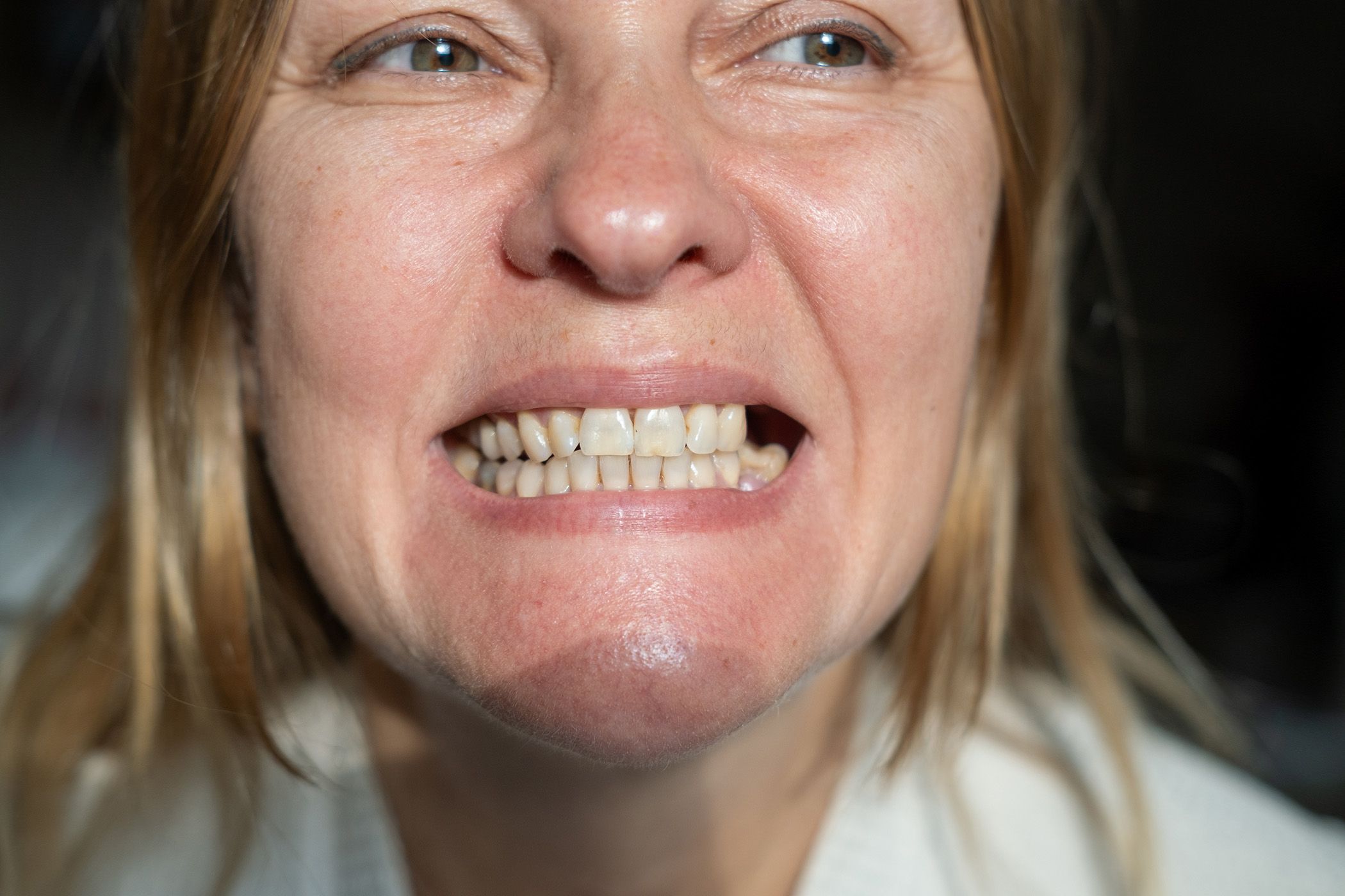 Image of a female baring her teeth to show her missing tooth.
