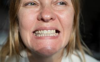 Image of a female baring her teeth to show her missing tooth.