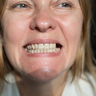 Missing teeth