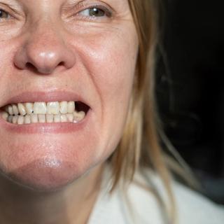 What Is a Dental Crown?