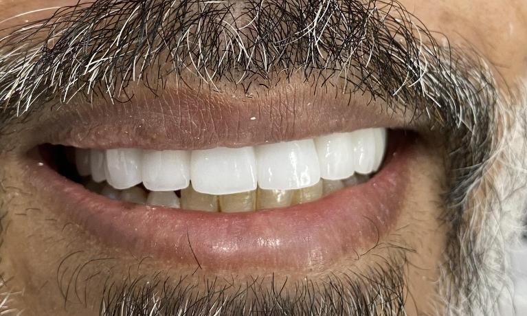 Cosmetic Dentistry - After
