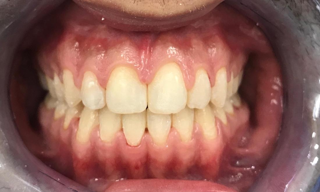 Braces and Invisalign - After