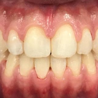 Braces and Invisalign - After