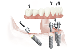 All-On-4 Dental Implant Guide