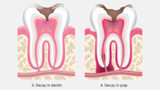 Second stages of tooth decay