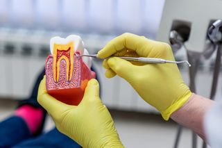 Root Canal
