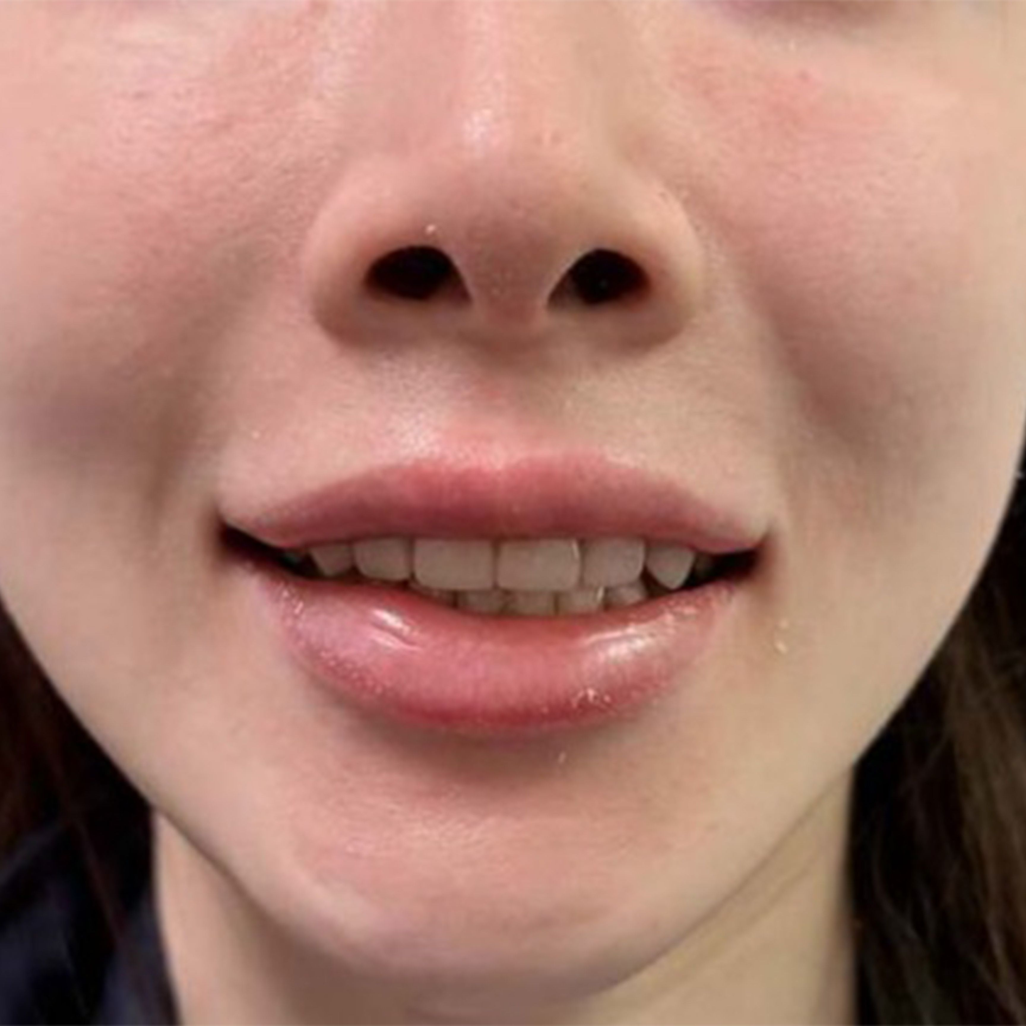 Porcelain Veneers