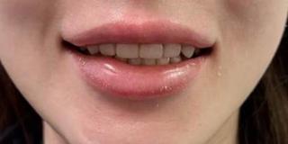 Porcelain Veneers
