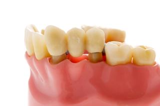 Dental bridge procedure