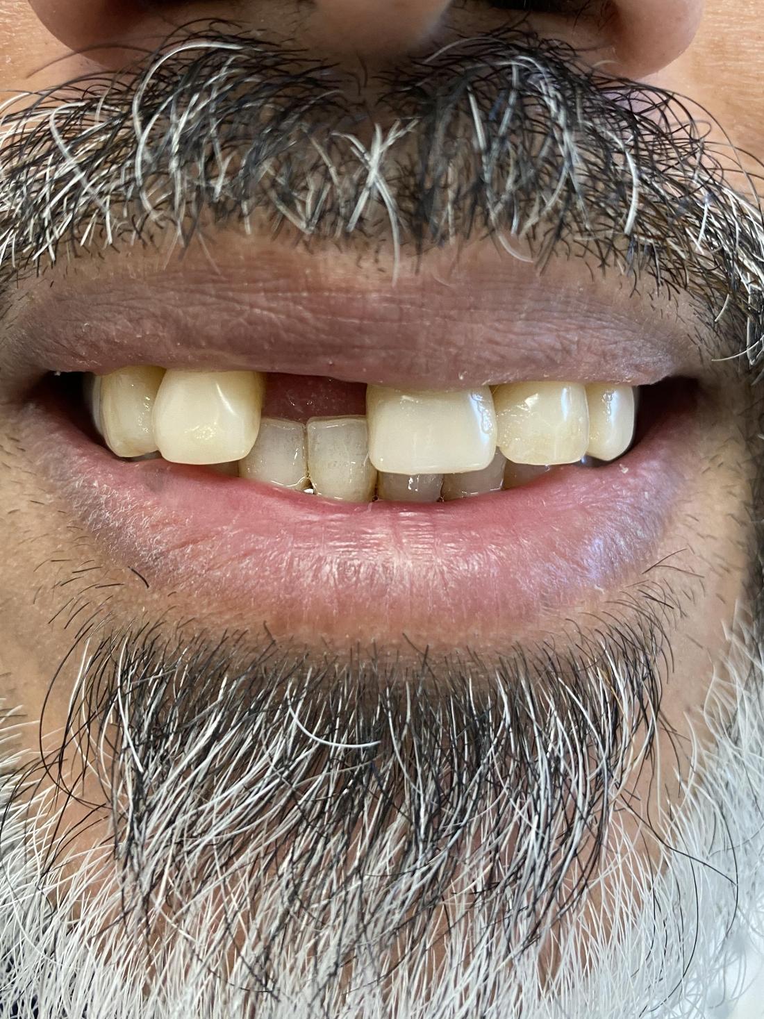 Cosmetic Dentistry - Before