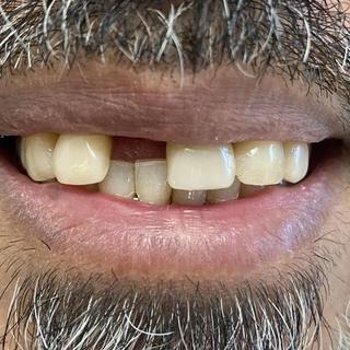Cosmetic Dentistry - Before