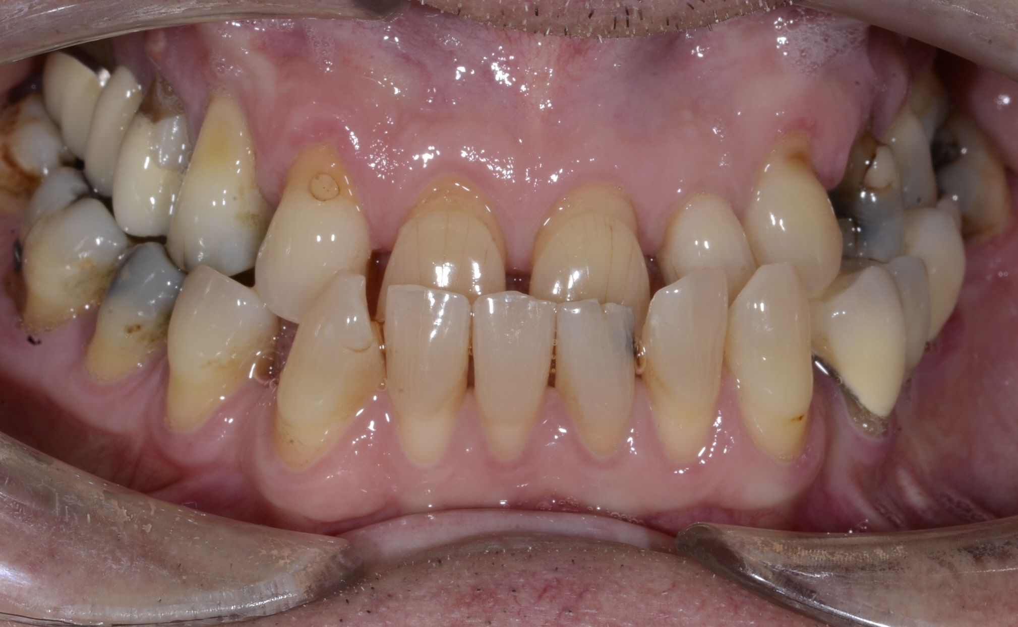  Norm before crown and bridge treatment.