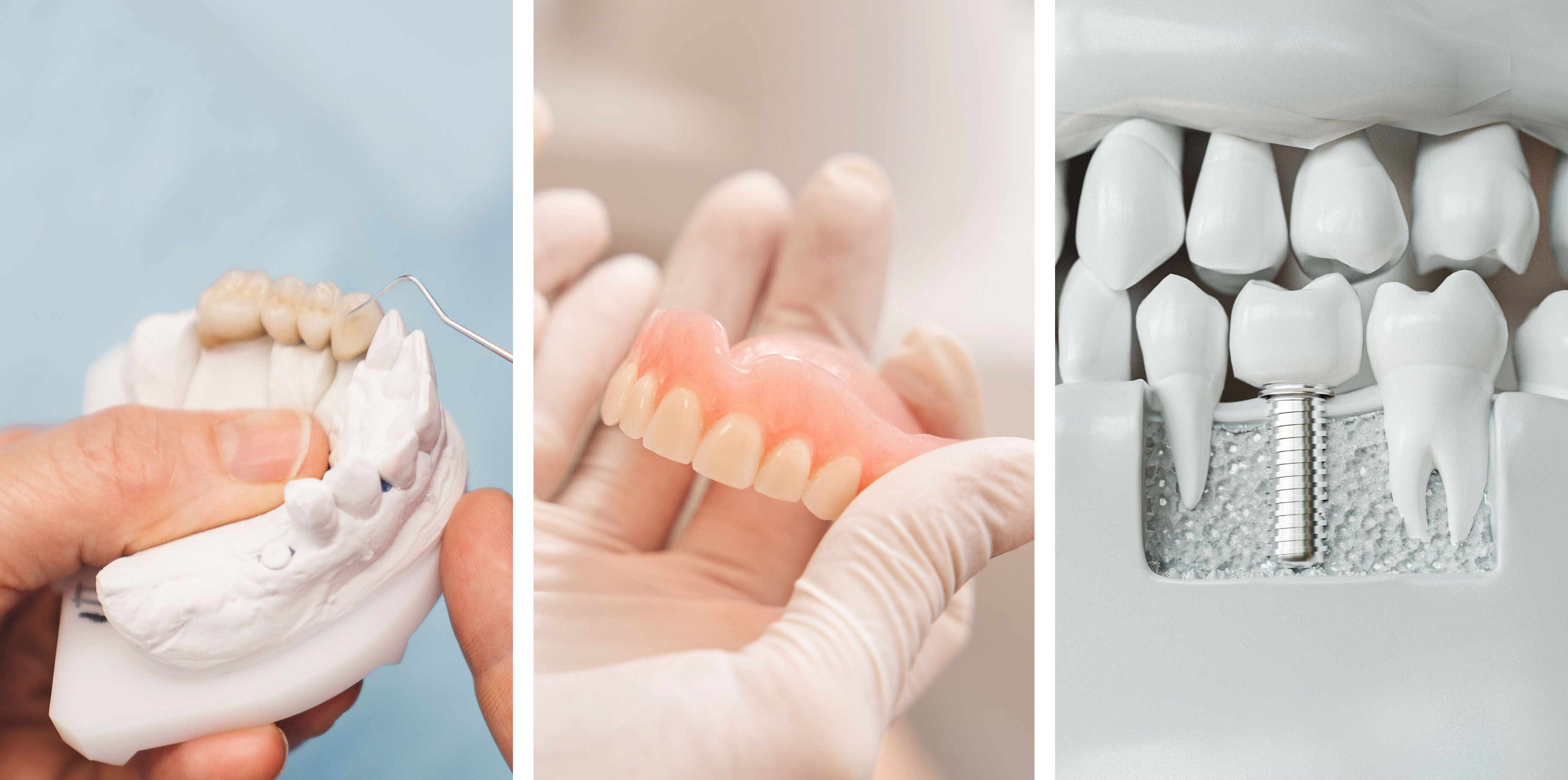 Bridges vs Dentures vs Implants