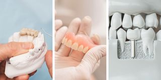 Bridges vs Dentures vs Implants