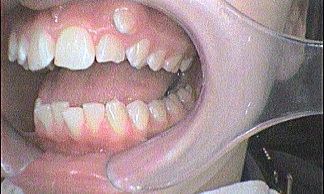 Braces and Invisalign - Before - Right Side